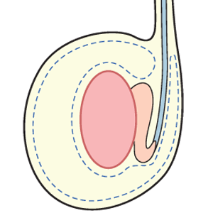 tunica vaginalis-Testicular-Mesothelioma